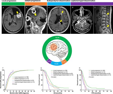 Find out more about grades of brain tumours. . Glioblastoma stages of progression